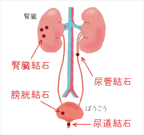 腎臓結石（腎結石）とは腎臓内にできた結石のこと